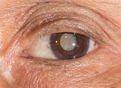 Image result for 白内障 eye cataract