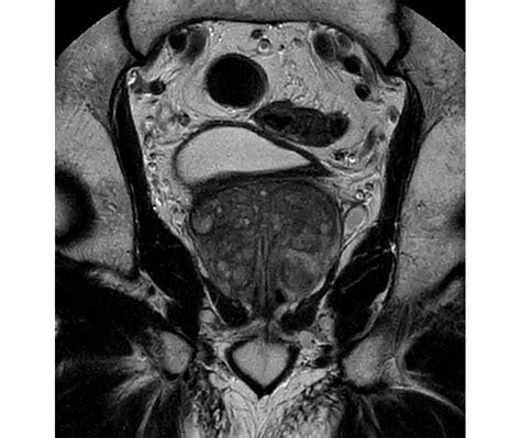 Philips - MultiVane XD - Pelvis MR clinical application