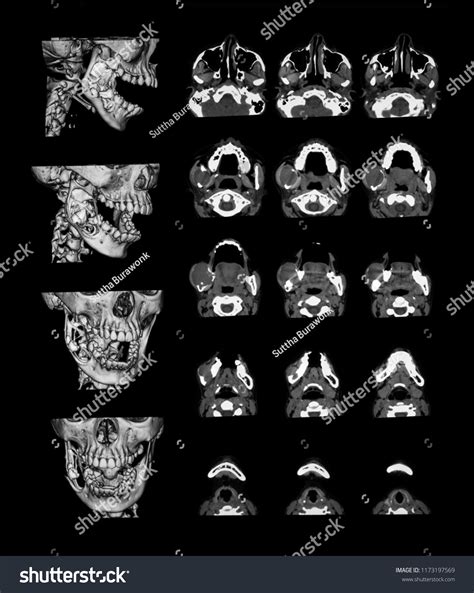 Keratocystic Odontogenic Tumor