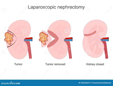 Nephrectomy is a Major Procedure Performed Stock Illustration ...