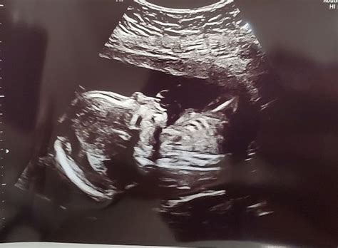 Any other babies with CHD? (Heart defect) | BabyCenter