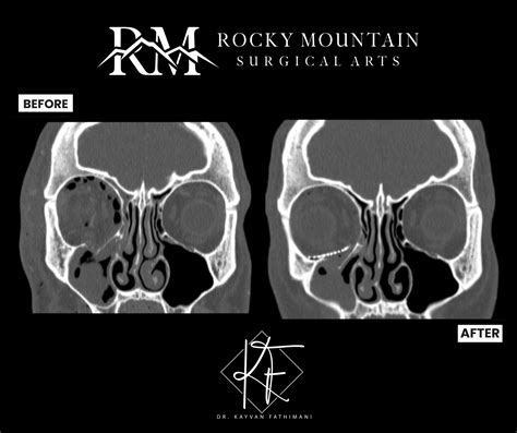 Facial Trauma Surgery Lone Tree, CO | Rocky Mountain Surgical Arts