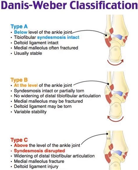 Weber classification of ankle fractures – Artofit