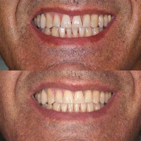 Smart Aligner 的图像结果