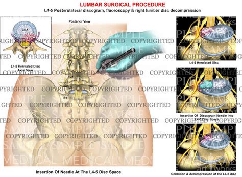 Image result for Lumbar Discogram