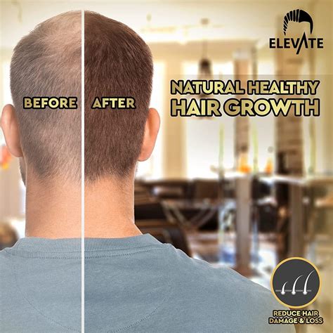 ELEVATE Hair Growth Oil - Biotin & Castor Oil Serum for Stronger, Thicker Hair Growth - Prevent ...