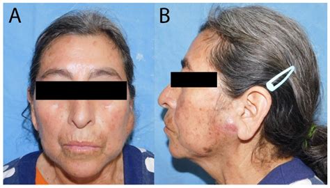 Parotid Gland Mass as the First Manifestation of Recurrent Metastatic ...