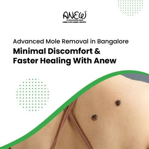 Mole Removal Treatment in Bangalore With Advanced Laser