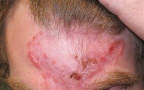 Image result for carcinoma cell