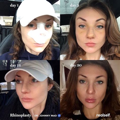 12 days post op open rhinoplasty & very happy with results so far. | Rhinoplasty, Nose job ...