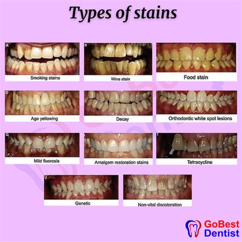 Teeth Discoloration / Stained Teeth - Gobest Dentist