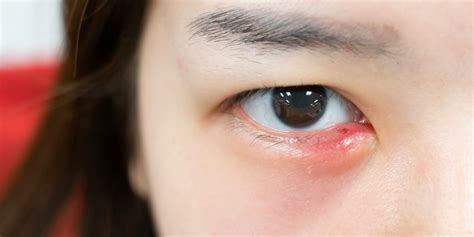 Stye Eye Corner