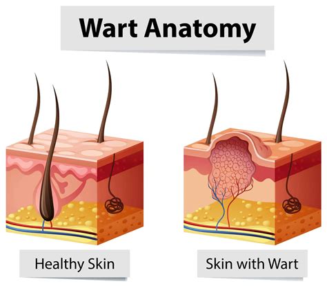 HPV and Genital Warts: Insights and Solutions | H.U.M. Clinic, Bangkok