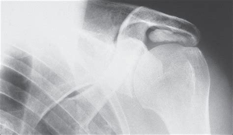 Basic calcium phosphate crystal deposition disease - Clinical Tree