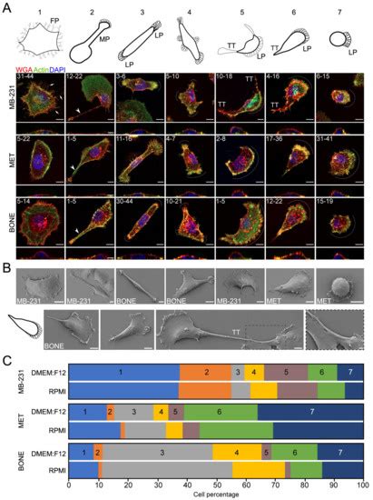 Cancers | Special Issue : Bone Metastasis in Breast Cancer