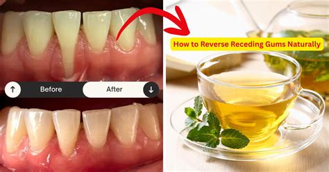 How to Reverse Receding Gums Naturally - Grandma Remedy