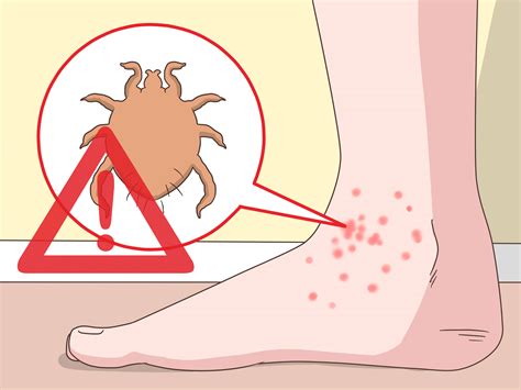 3 Ways to Stop Itchy Feet - wikiHow