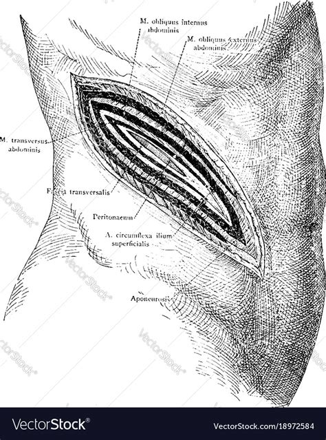 Image result for Flank Incision Nephrectomy
