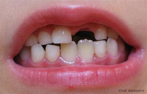 The Differences Between Baby Teeth and Permanent Teeth | Oral Answers