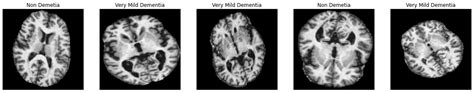 CAD-ALZ: A Blockwise Fine-Tuning Strategy on Convolutional Model and ...