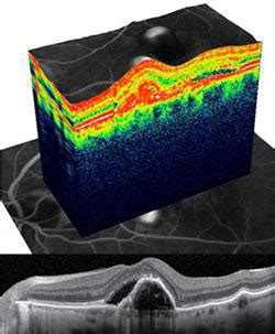 PASCAL LASER & SPECTRAL OCT-SLO in Chandigarh | Grover Eye
