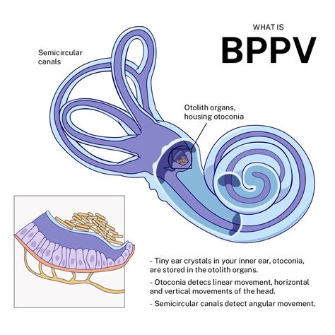 BPPV — The Vertigo Co