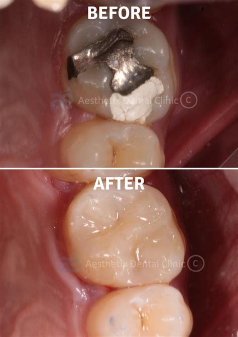 Tooth coloured restorations, Tooth fillings, Cavity fillings ...