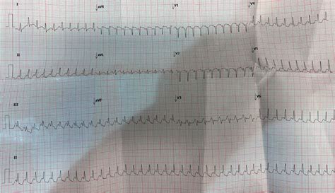 A Case of Palpitations in Pregnancy - Journal of Emergency Medicine