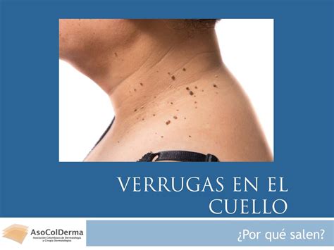Este Es El Significado De Las Verrugas En El Cuello