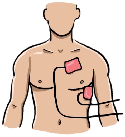 Cardiac Arrest and Complete Heart Block: Complications after Electrical ...