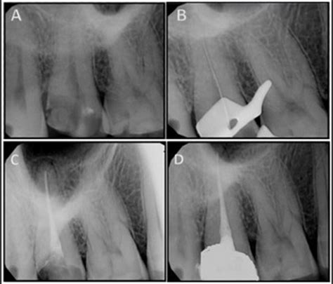 Maxillary second molar with morphologic variations in number of roots ...