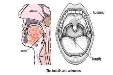 Adenoid removal - Brain and ENT Clinic - Dr Lalit Mahajan In Nagpur ...