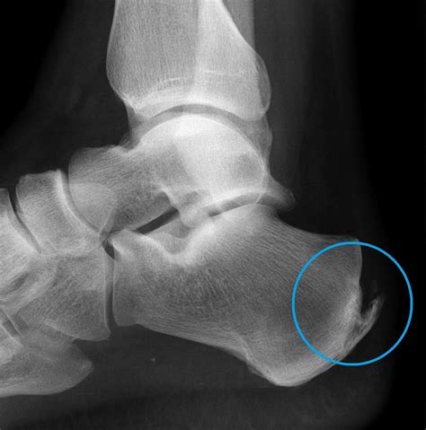 Plantar Heel Spur Surgery at Henry Lymburner blog
