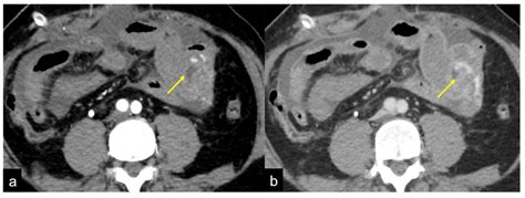 Tomography | Free Full-Text | The Role of CT-Angiography in the Acute ...