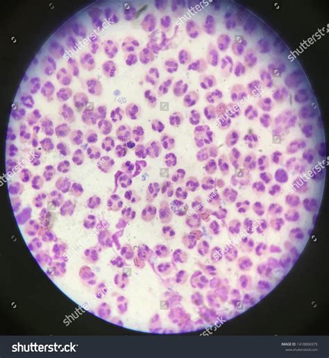 Neisseria Gonorrhoeae 1000x Bifidobacterium: An Emerging Clinically