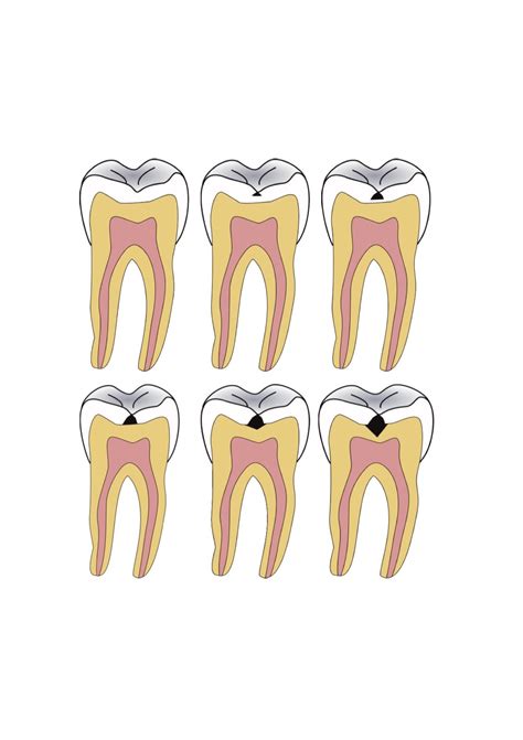 Las seis principales causas de las caries - Clínica Blasi