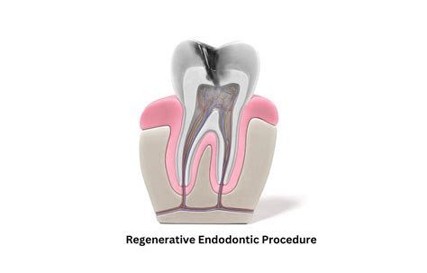 Regenerative endodontic procedures may help detect root canal calcification