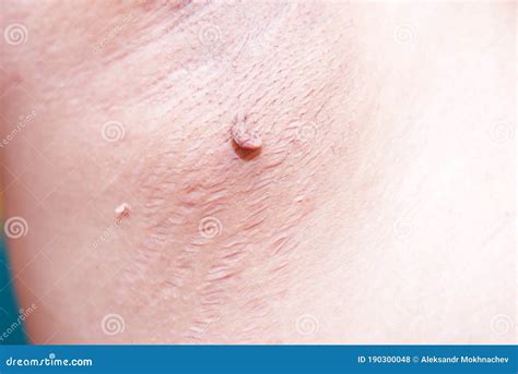 A Sore in the Armpit in a Person. Stock Photo - Image of people, male: 190300048