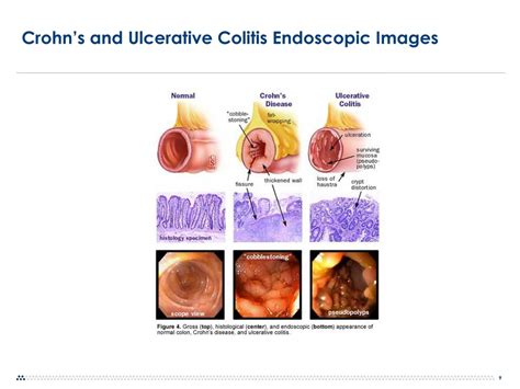 PPT - Inflammatory Bowel Disease Update: Crohn's vs. Ulcerative Colitis ...