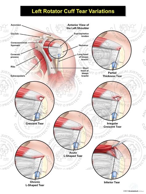 Image result for Left Rotator Cuff