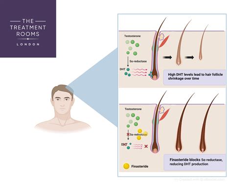 Does Ketoconazole Cause Hair Loss