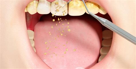 Tartar Calculus Removal: Keep Gums Clean & Healthy