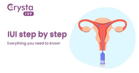 How Is IUI Procedure Done 的图像结果