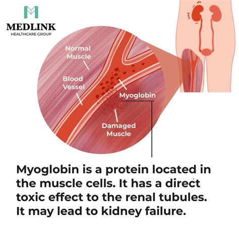 Understanding Rhabdomyolysis: Causes, Symptoms, Prevention, and ...