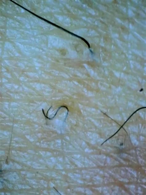 How to get rid of ingrown hair scars quickly – Artofit