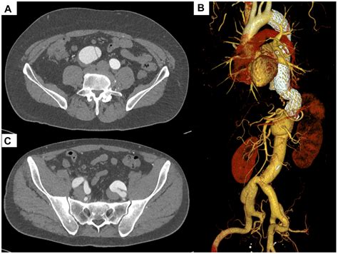 Endovascular repair of bilateral common iliac artery aneurysms using ...