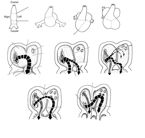 Image result for Heart Development Disorders