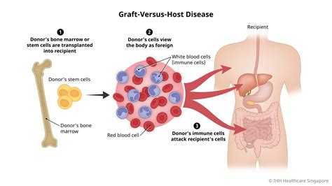 Graft-Versus-Host Disease (GvHD) - Symptoms & Causes | Gleneagles Hospital