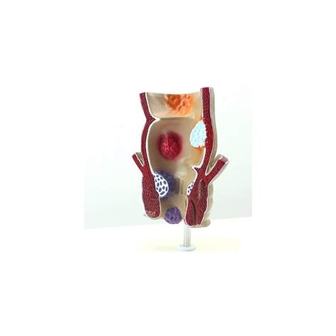 Buy Medical Science Rectum Fissure Lesion Model 1.5X Human Anorectal ...