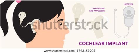 Image result for Cochlear